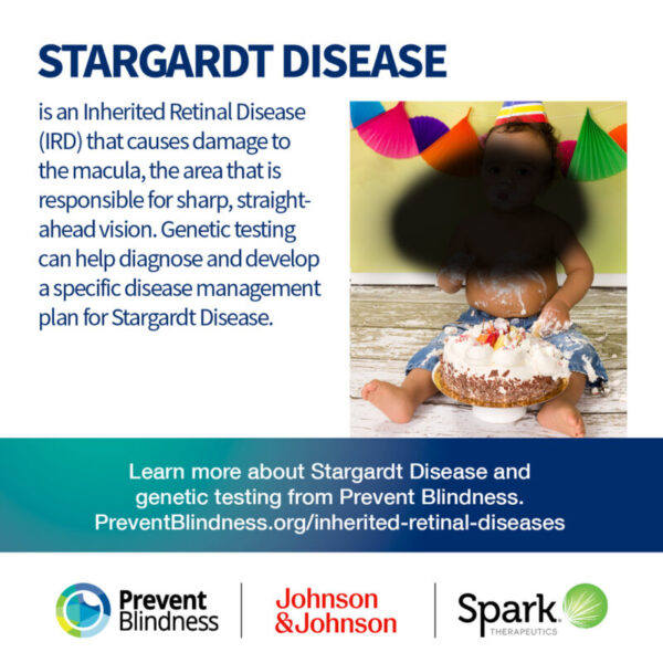 Stargardt disease is an inherited retinal disease (IRD) that causes damage to the macula. Find out more at https://preventblindness.org/inherited-retinal-diseases